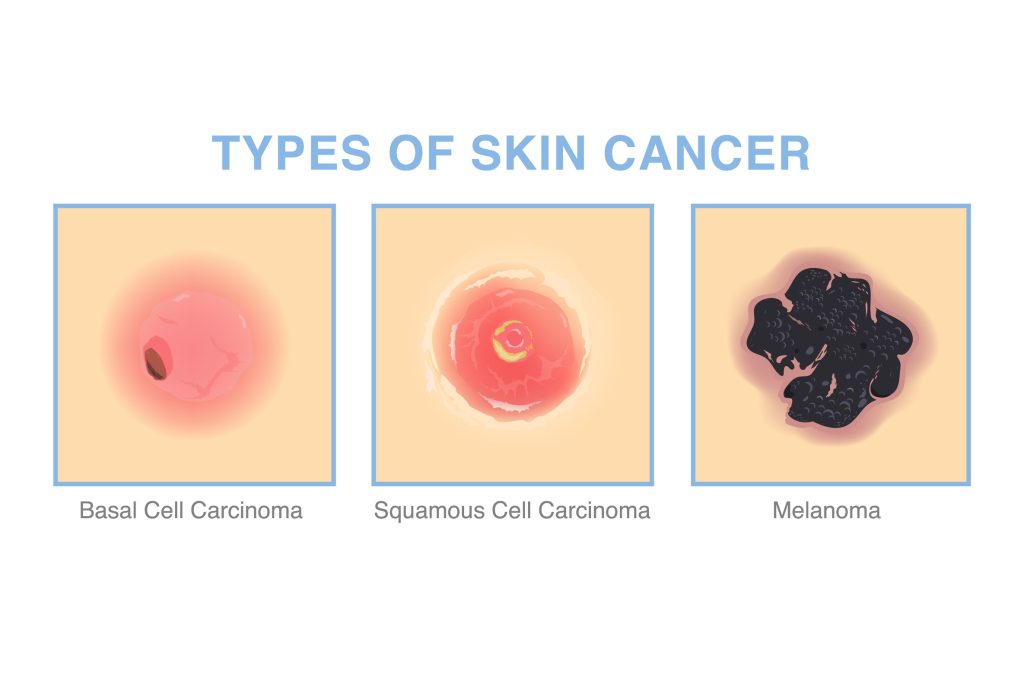 Mohs Surgery For Skin Cancer